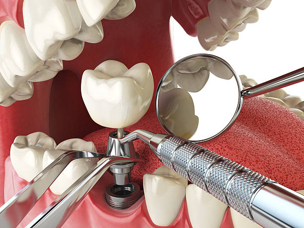 Best Emergency Tooth Extraction in Chenoa, IL